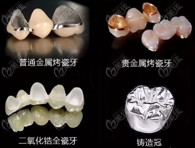 根管治疗后可以选择戴的牙冠