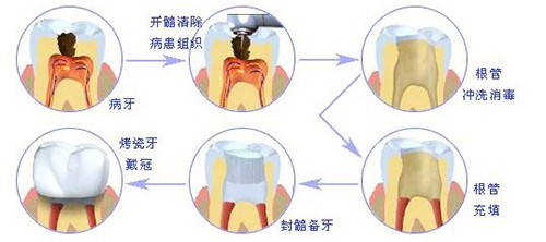 根管治疗加牙冠多少钱一颗牙?通过2024年全新价格表来了解下~