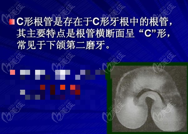 C形根管的介绍