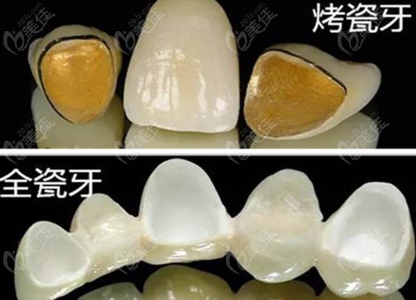 全瓷牙冠和烤瓷牙冠的图