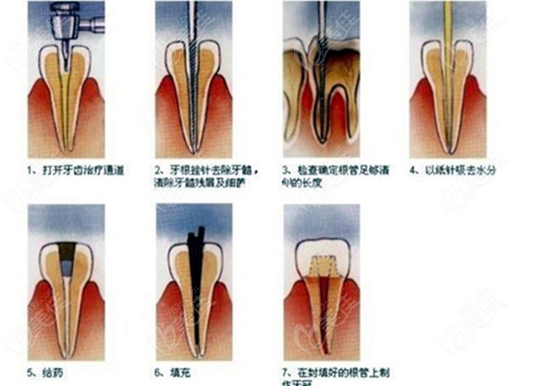 根管治疗的流程图