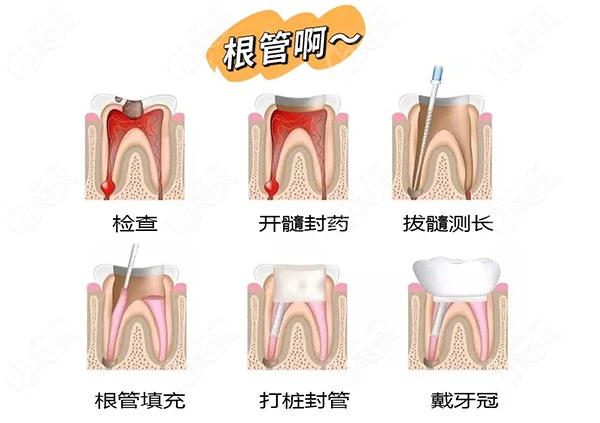 根管治疗的过程要几次