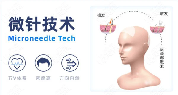 哈尔滨大麦微针植发技术