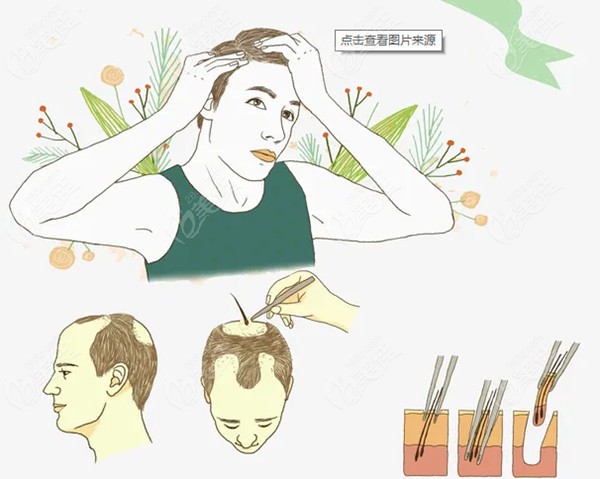 深圳比较出名的植发医院名单