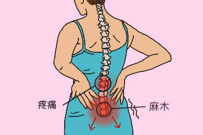 腰椎间盘突出症导致后背疼痛图