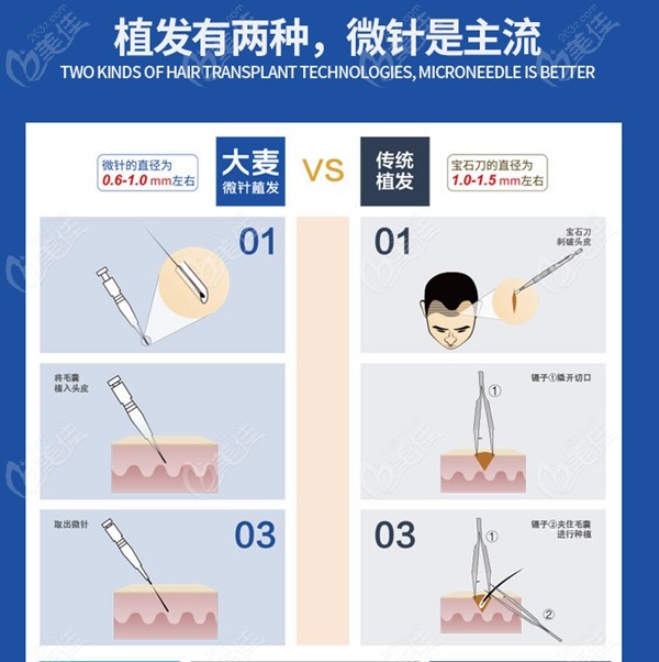 大麦微针植发技术优势