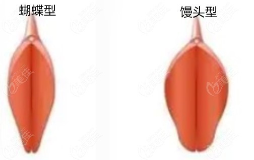 阴唇馒头型的好还是蝴蝶型的好看美佳网