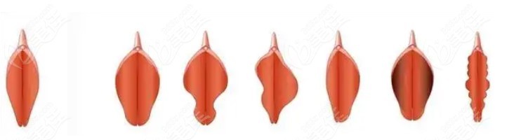 女性阴唇形状图片放大