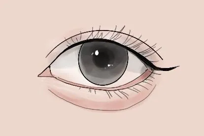卧蚕眼图片