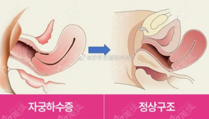 好手艺后方膣圆盖手术过程图示