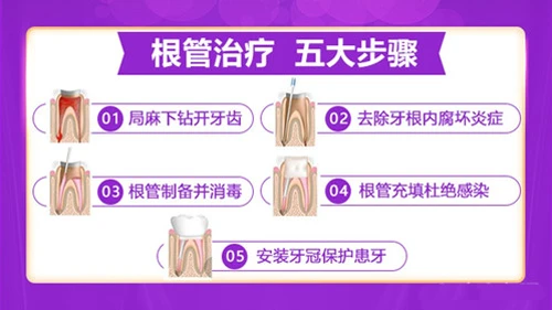 根管治疗2024最新价格表来啦！前牙300+，后牙400+，后磨牙600+，快来了解！